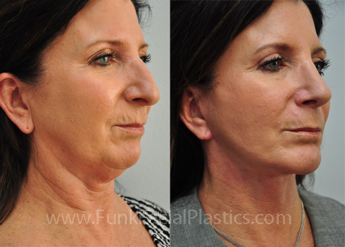 Nose Surgery Houston