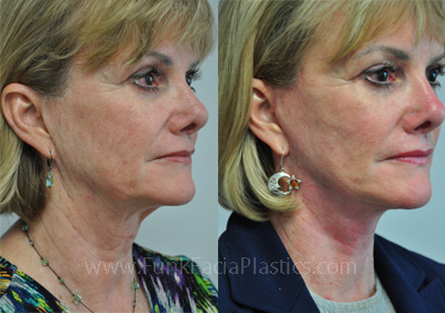 houston facelift patient