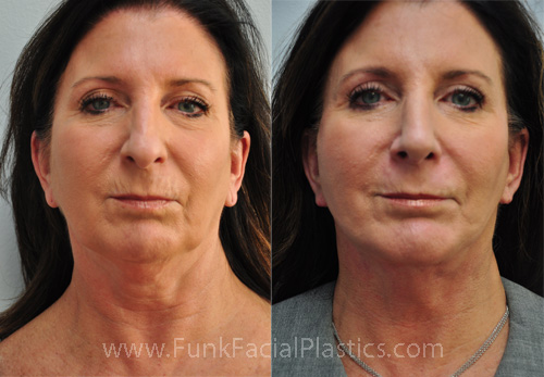 Rhinoplasty Houston with Facelift