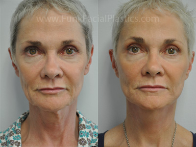 top face lift surgeon in houston