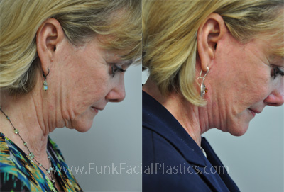 best facelift surgeon houston