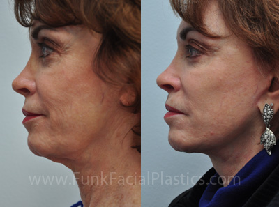 Neck Lift Houston