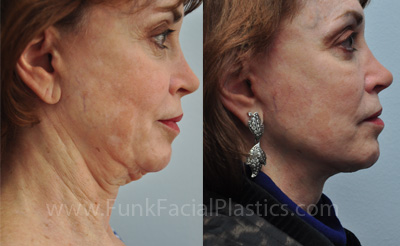 Best Facelift Surgeon in Houston