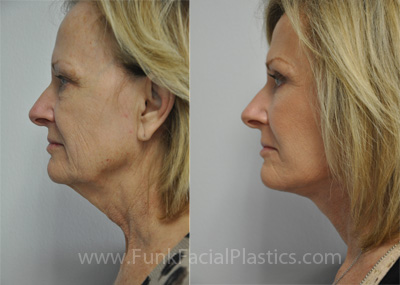 houston facelift patient