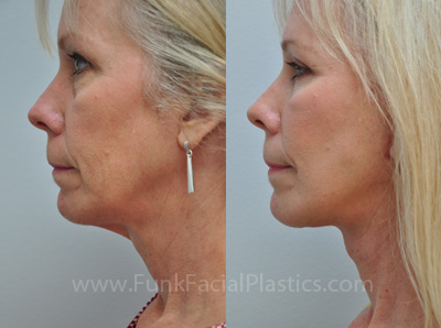 Face and Necklift in Houston