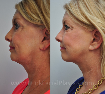 Neck after Facelift Houston