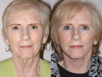 Best Facelift Surgeon Houston