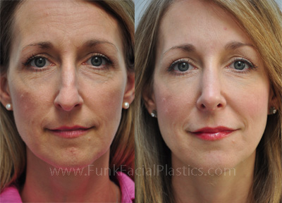 Best Rhinoplasty Surgeon Houston