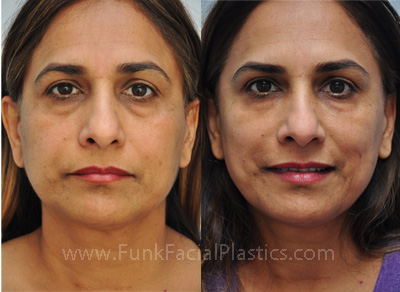 Filler for under eye bags Houston