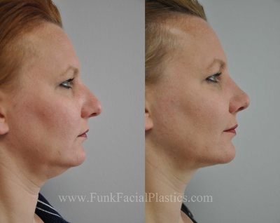 Houston Neck liposuction