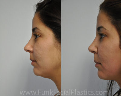 Neck liposuction Houston