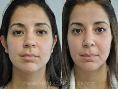 Neck lift Houston