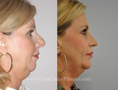 Chin implants Houston