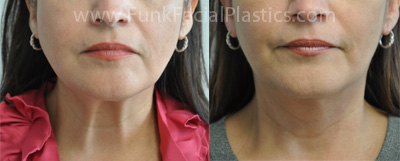 Neck Lift Houston