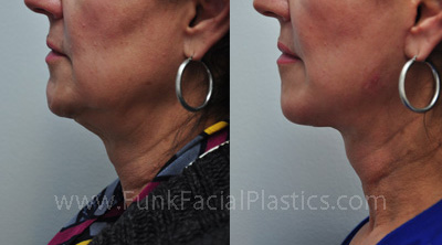 Neck lift Surgeon in Houston