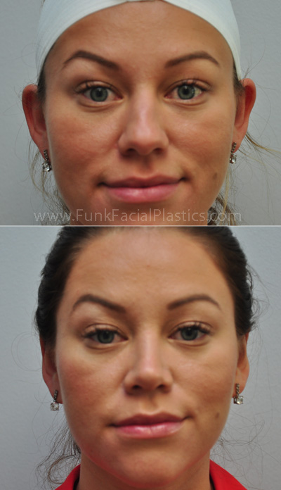 Otoplasty Houston