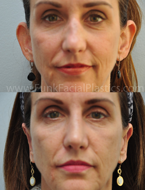 Otoplasty Procedure in Houston