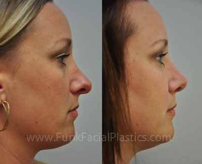 Botched nose job Houston