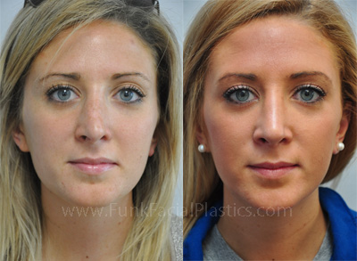 Revision Rhinoplasty Surgeon in Houston