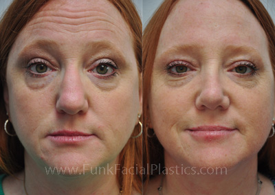 Best Rhinoplasty Surgeon in Texas