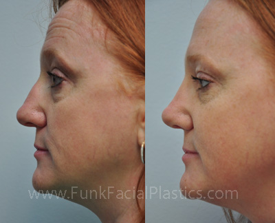 Top Nose Surgeon in Texas