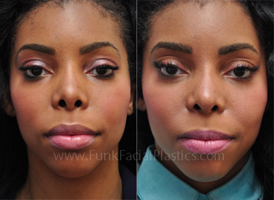 Ethnic Rhinoplasty Houston