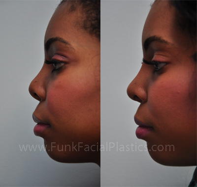 Ethnic Nose Surgery Houston