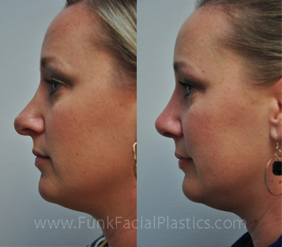 Revision Nose Job Houston