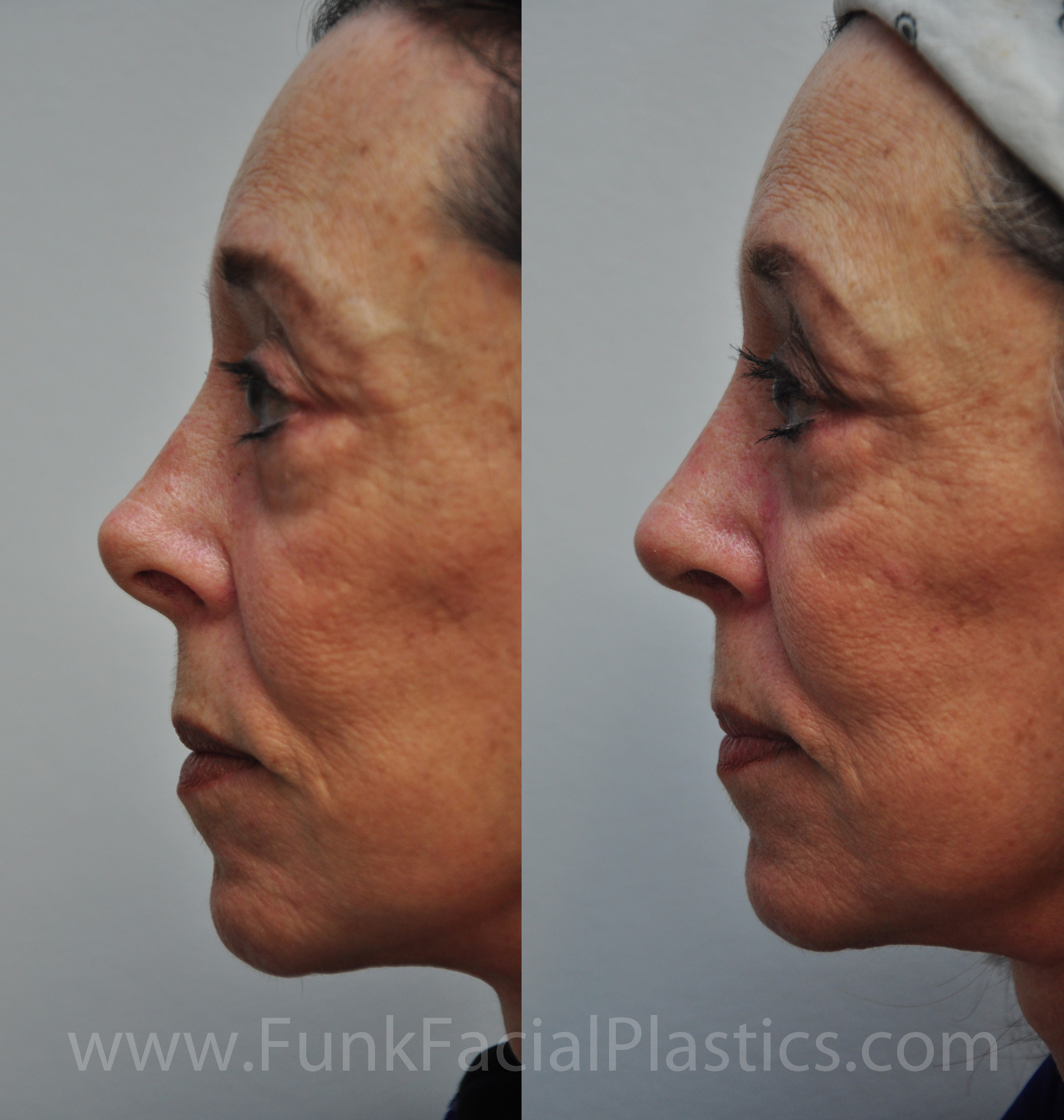 Revision Rhinoplasty Houston