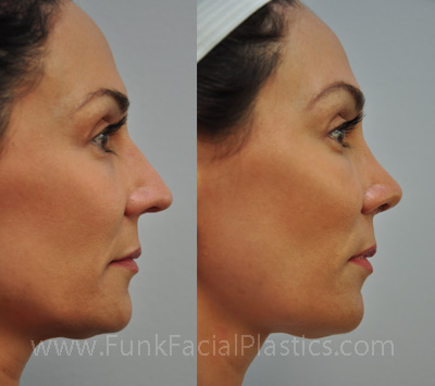 Best Revision Nose Job Surgeon in Texas