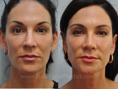 Revision Rhinoplasty Houston