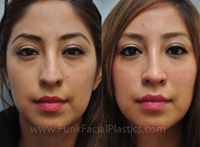 revision rhinoplasty expert houston