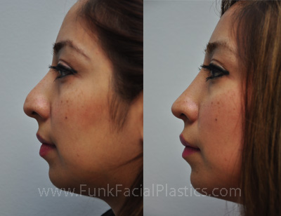 Revision Rhinoplasty Houston