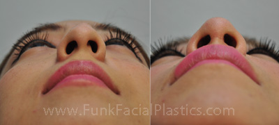 Assymetric Nostrils after rhinoplasty