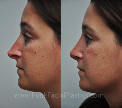 How long do I have to wait after rhinoplasty for a revision?