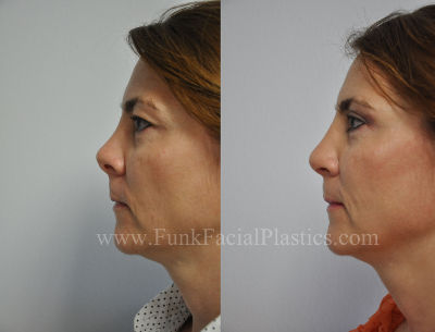 Revision nose surgery for woman in Houston