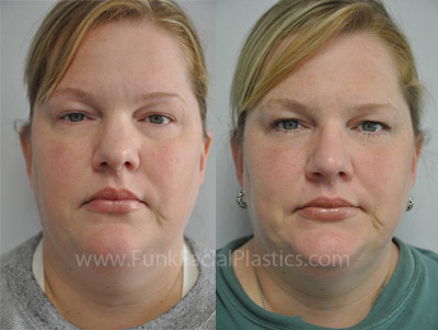 Rhinoplasty Houston