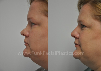 Nose Job Houston