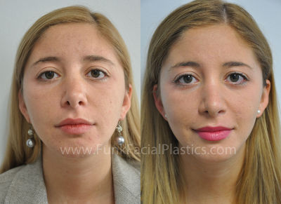 Nose Surgery Revision rhinoplasty - Upturned nose > Before & After Photo