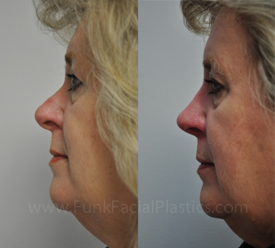 Revision Nose Job Houston