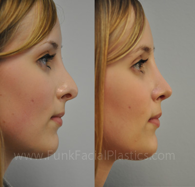 Revision Nose surgery Houston