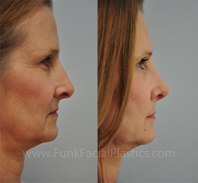 Revision Nose Surgery Houston