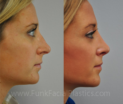 Revision Nose Job Houston