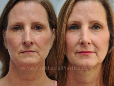 Revision Rhinoplasty Houston