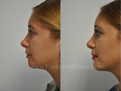 Rhinoplasty Houston