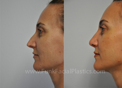 Houston Revision Rhinoplasty Patient