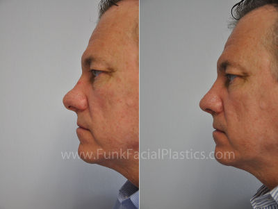 Revision Rhinoplasty Houston for Male