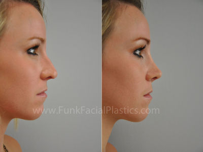 Revision Rhinoplasty Houston with Etai Funk