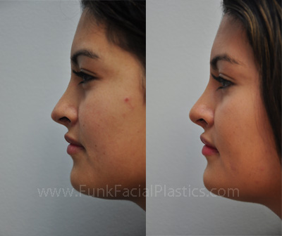 Revision Nose Surgery Houston