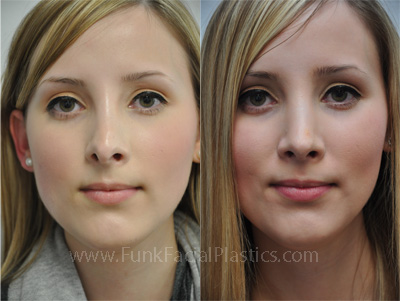 Revision Rhinoplasty Houston